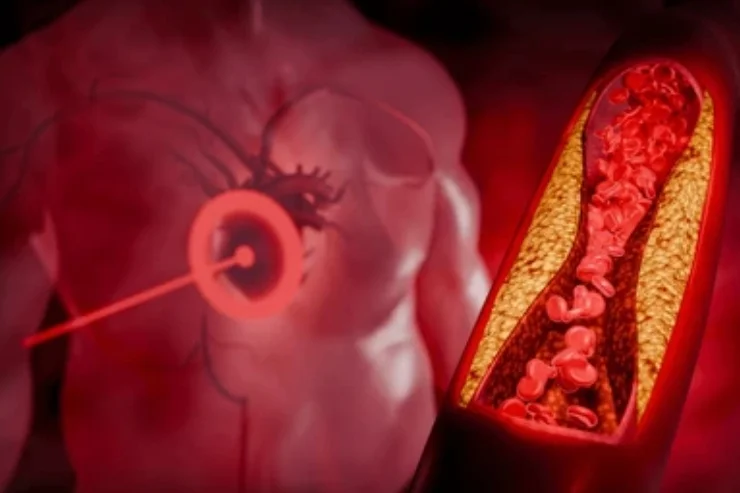 Hyperlipidaemia Management Program